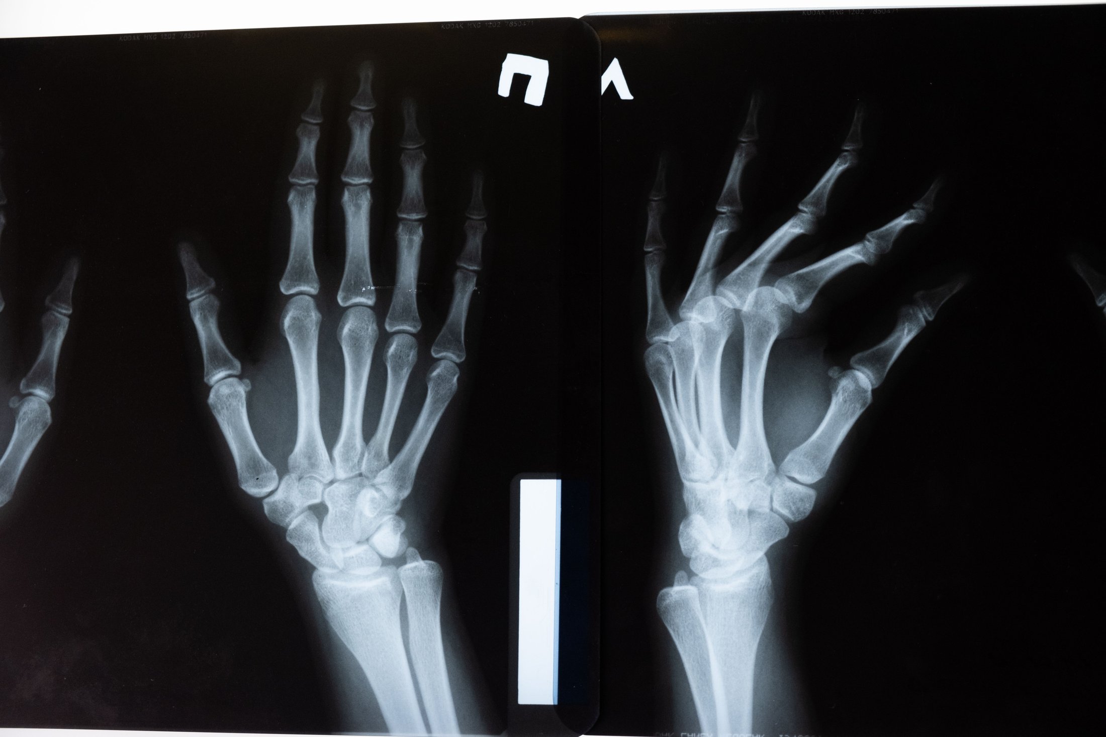 X-ray image of hands representing bone-density assessment